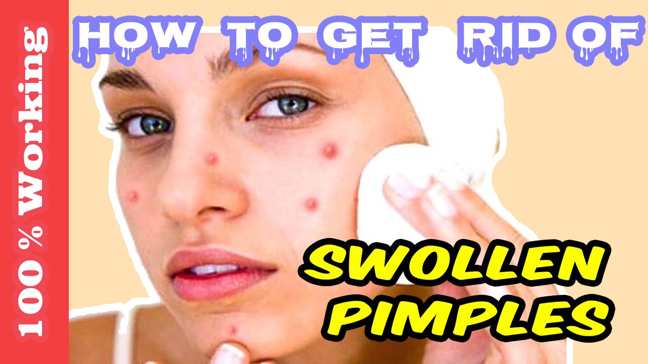 How To Get Rid Of Swollen Pimples Under The Skin