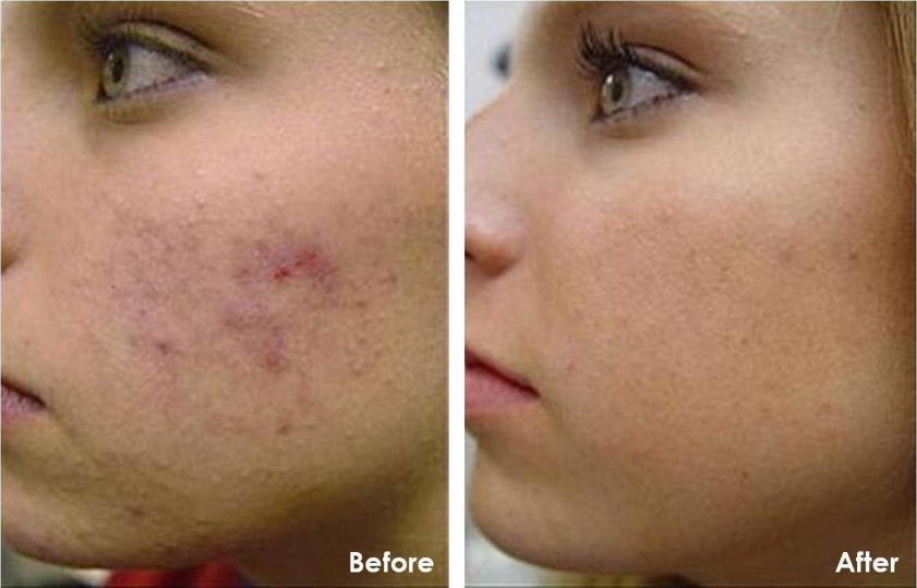 Fast Rid Painful Pimples Get How Of To
